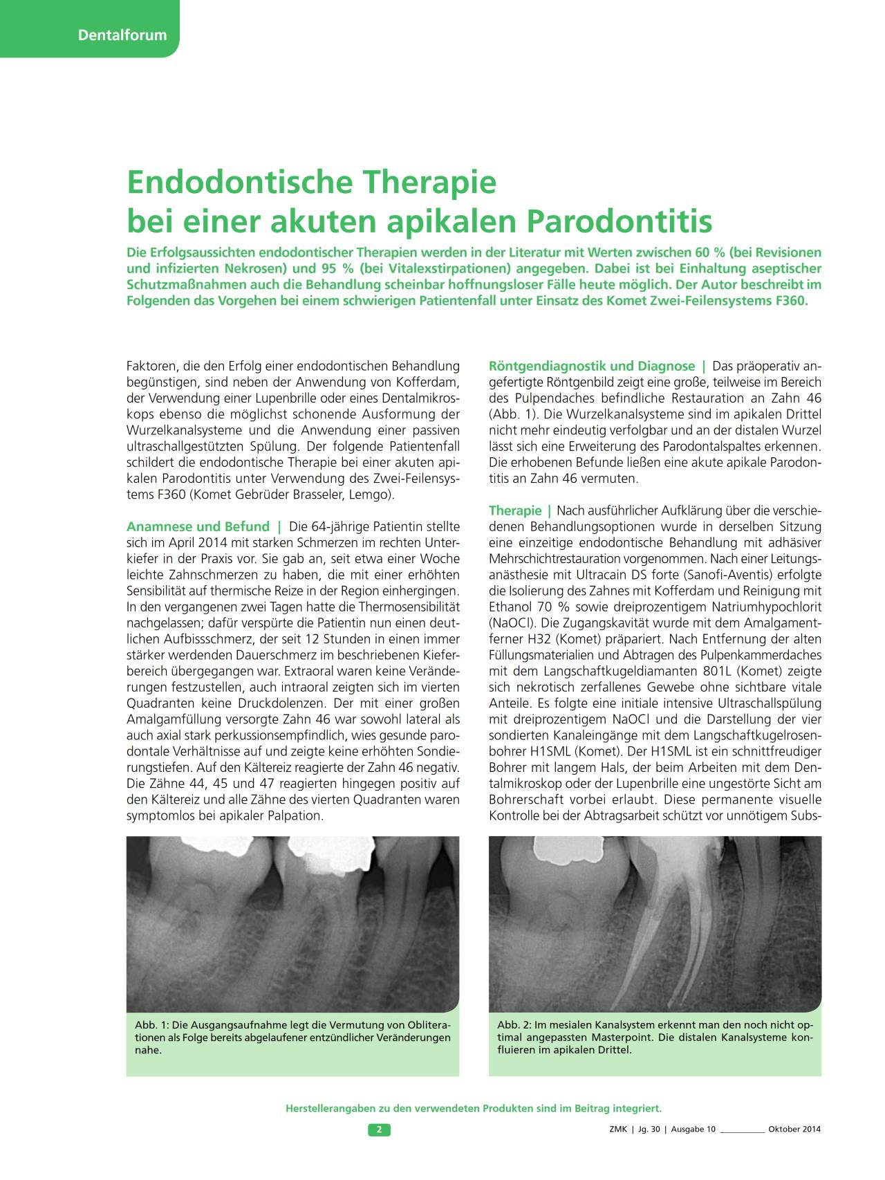 FB | Endodontische Therapie bei einer akuten apikalen Parodontitis ...