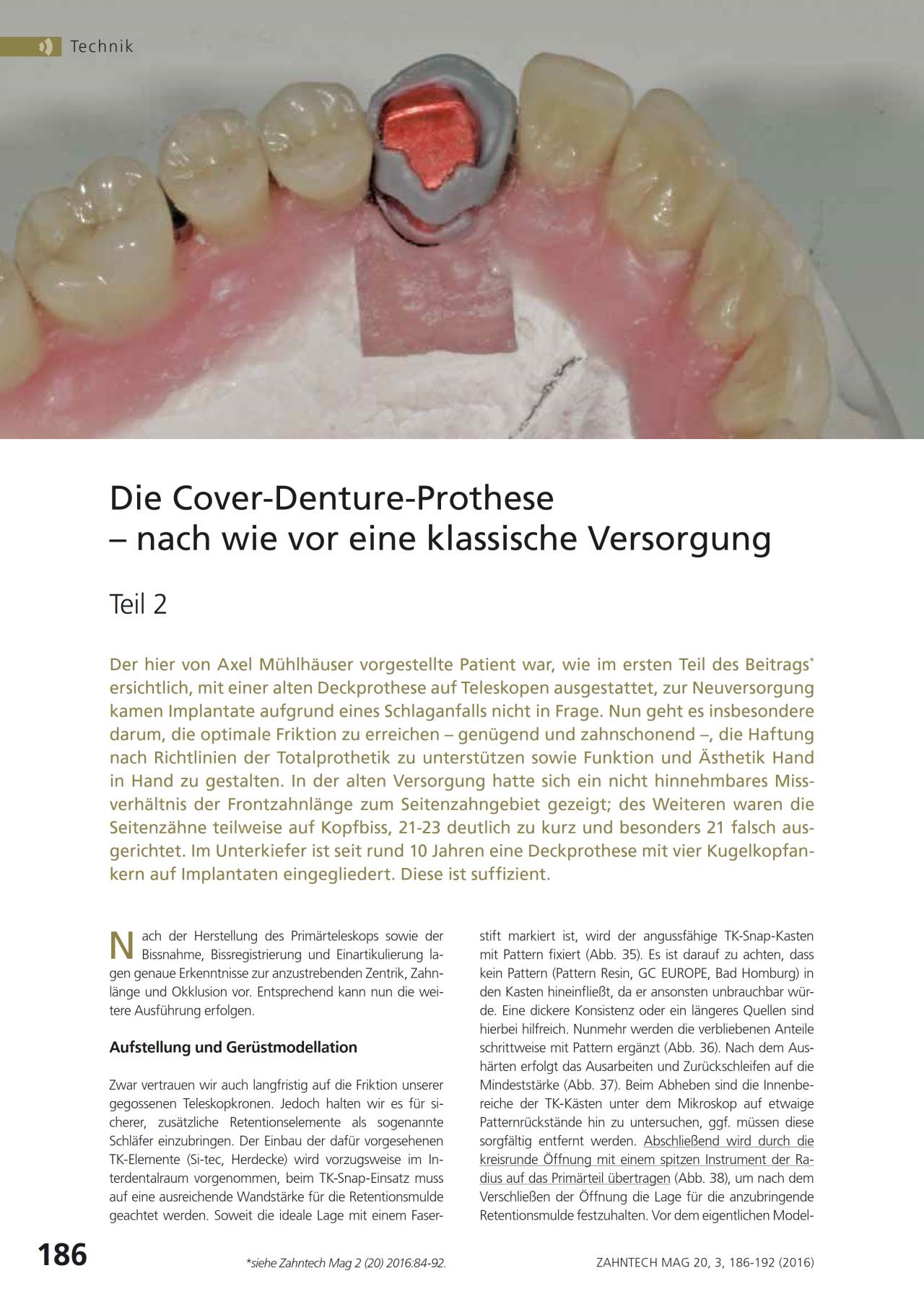FB Die CoverDentureProthese Teil 2 › Komet Magazin