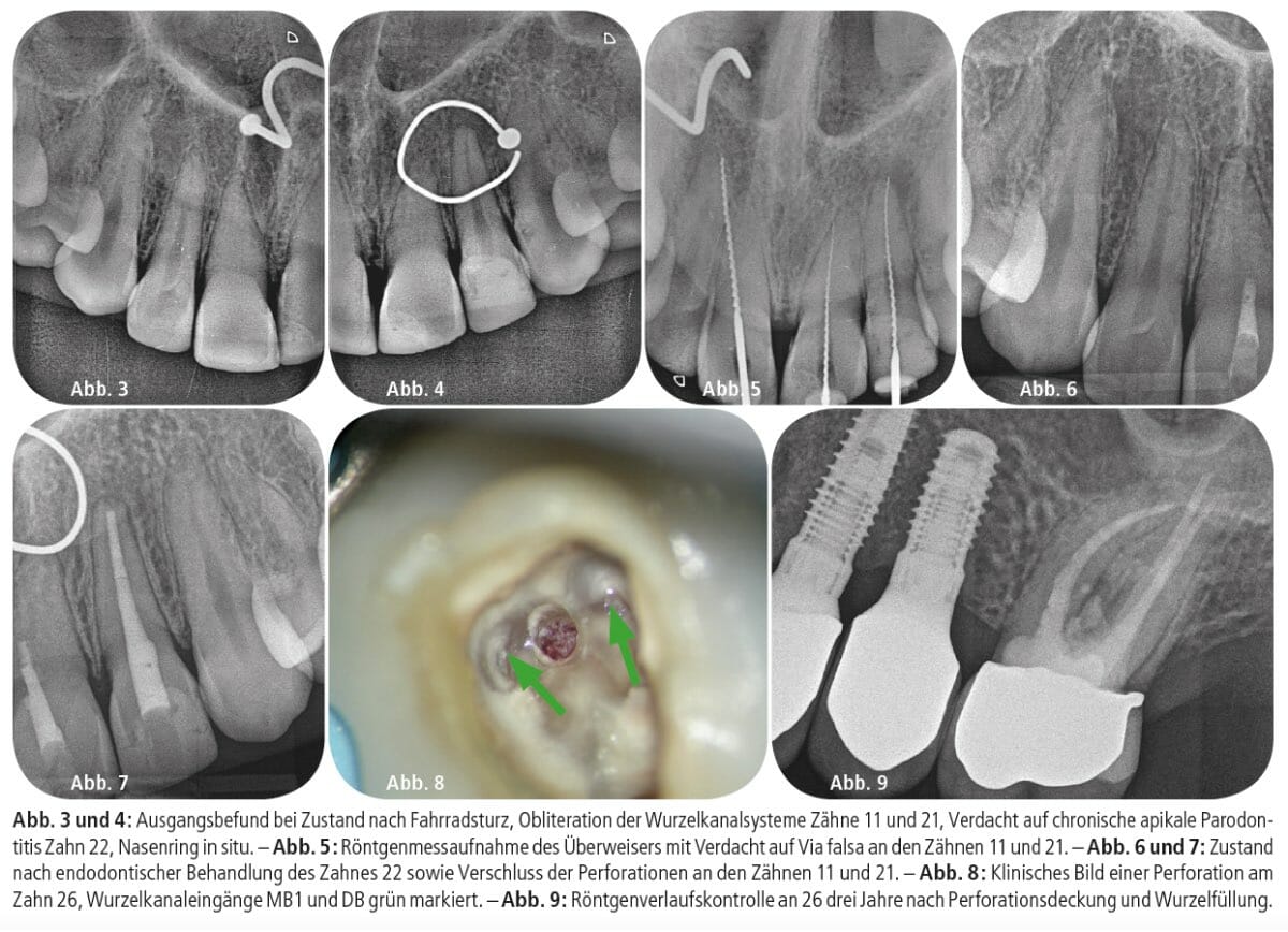 Wurzelkanalsysteme Zähne