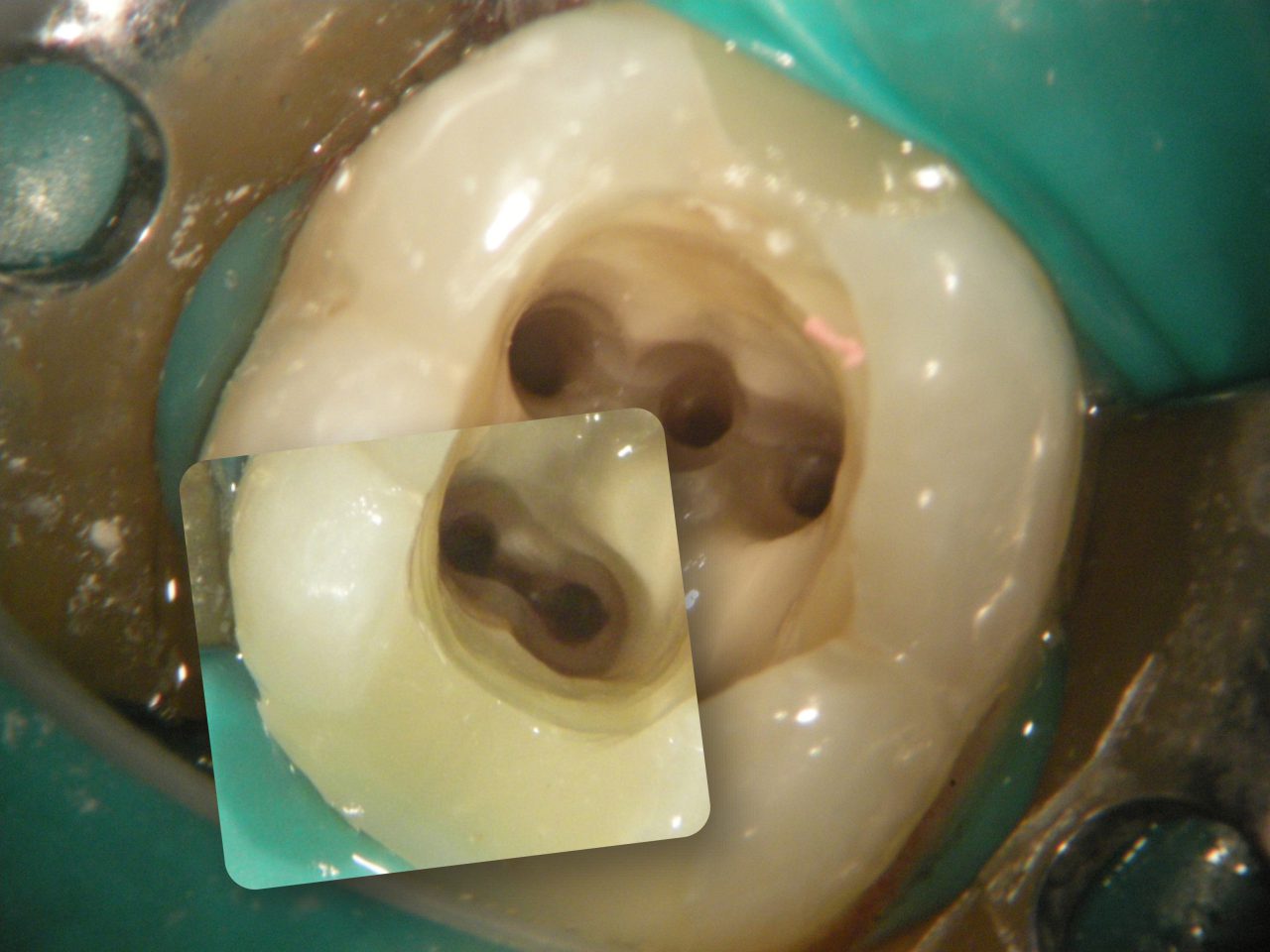 Wurzelkanäle effektiv darstellen: Herausforderungen und Methoden